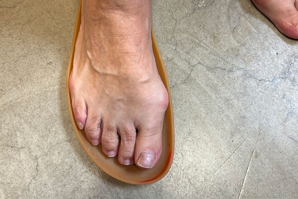 Hallux Valgus Schuhe