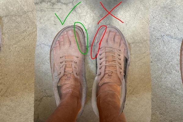 fuß mit halux problem in zu engen und passendem schuh links rechts unterschiedlich