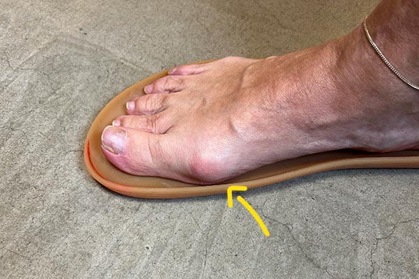 damen fuß mit hallux valgus problemen
